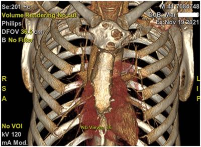 Case report: Post-thoracic surgery acquired venous thoracic outlet syndrome